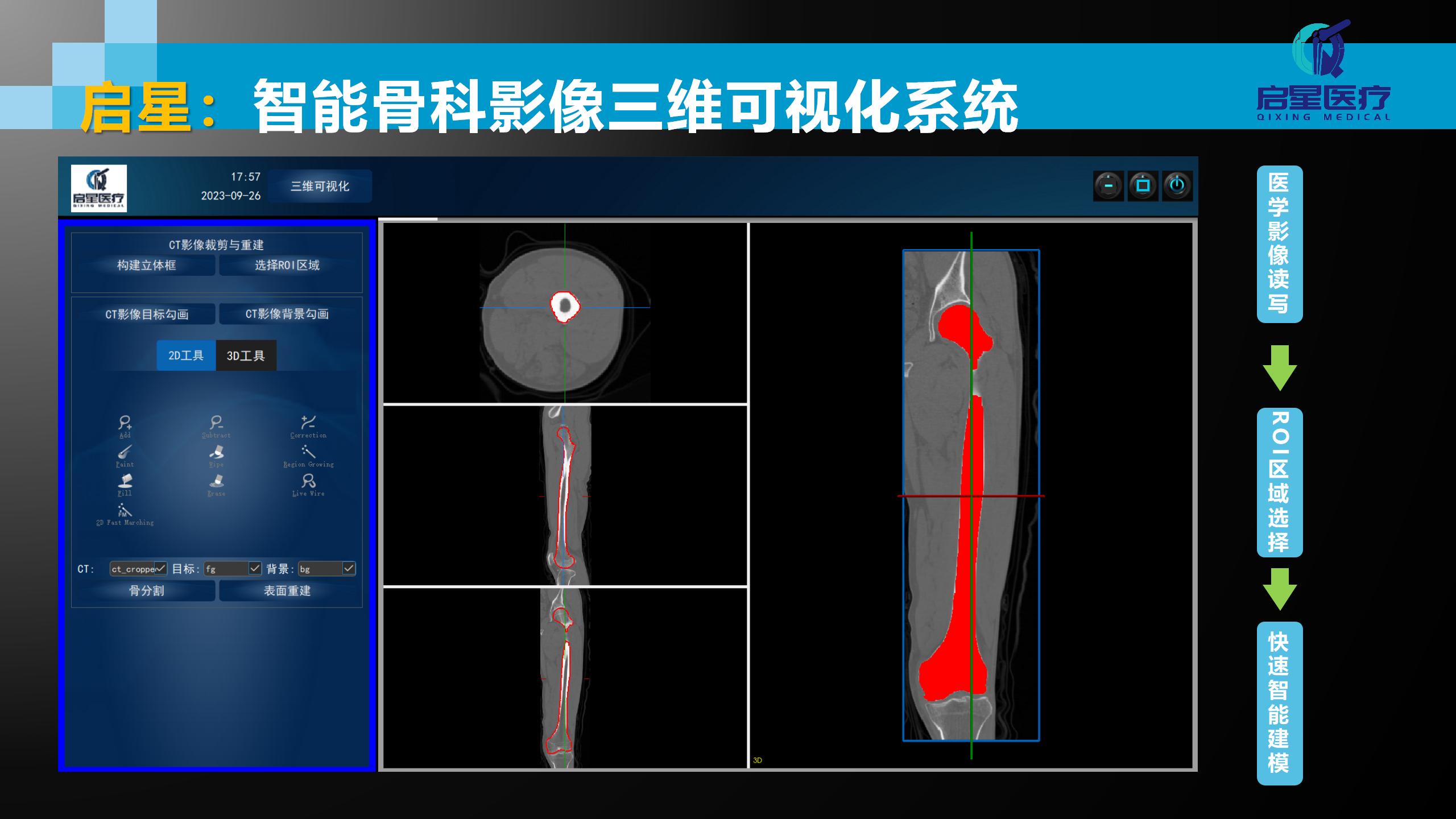 骨科三维可视化系统平台
