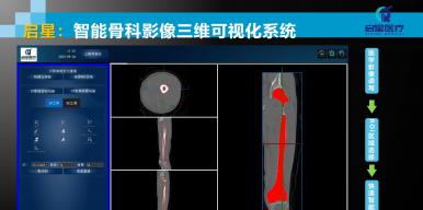 骨科三维可视化系统平台